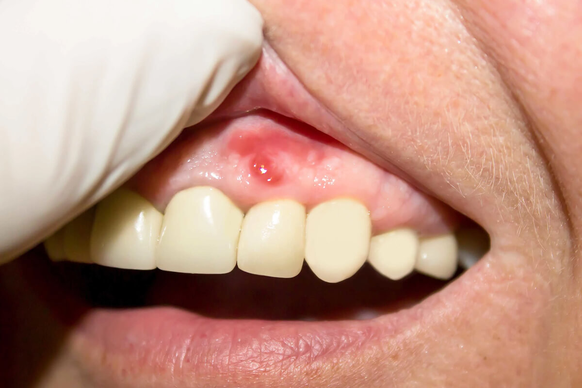 Apseli Dişlere Evde Bakım Nasıl Yapılır?