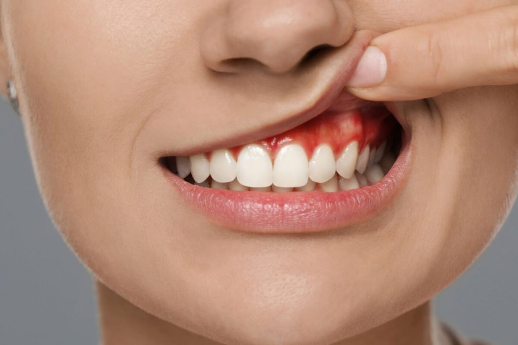 Diş Apsesi Kendiliğinden İyileşir Mi?