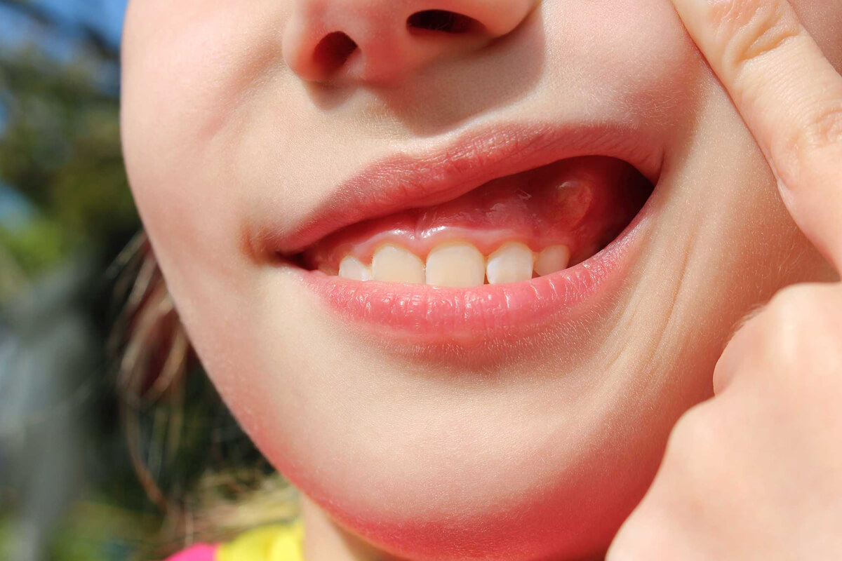 Diş Apsesi Neden Olur?