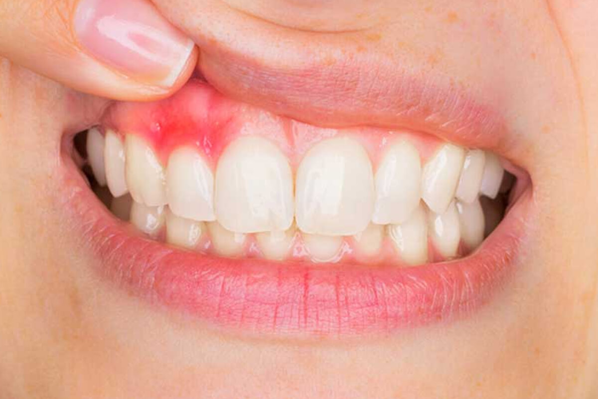 Diş Eti Çekilmesinin Önlenmesi İçin Neler Yapılabilir?