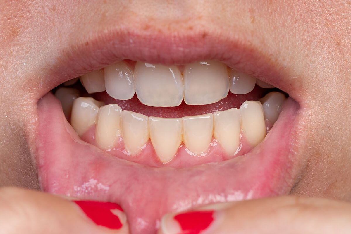 Diş Eti Çekilmesinin (Periodontitis) Tanısı Nasıl Konulur?