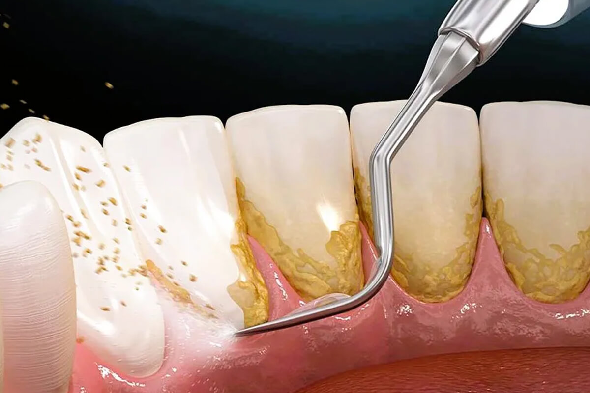 Diş Taşı Belirtileri