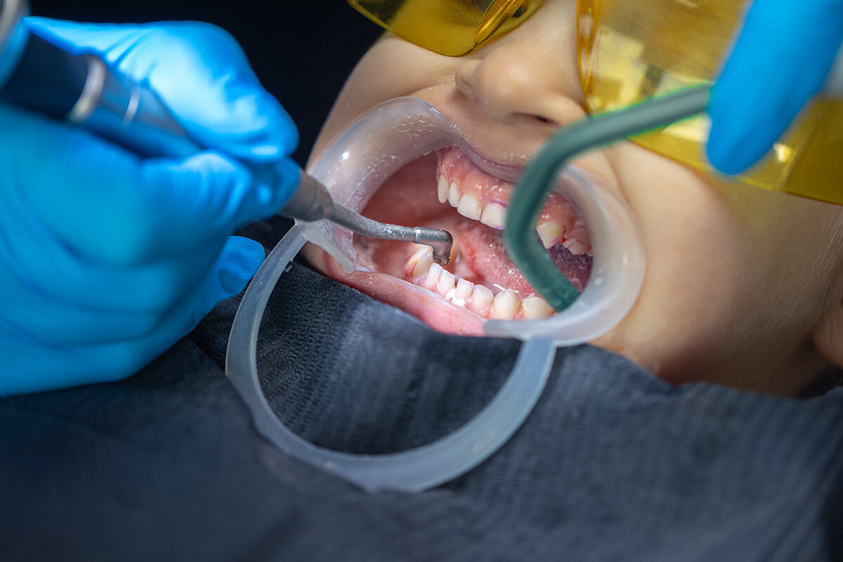 Dolgu Tedavileri Hangi Durumlarda Yapılır?