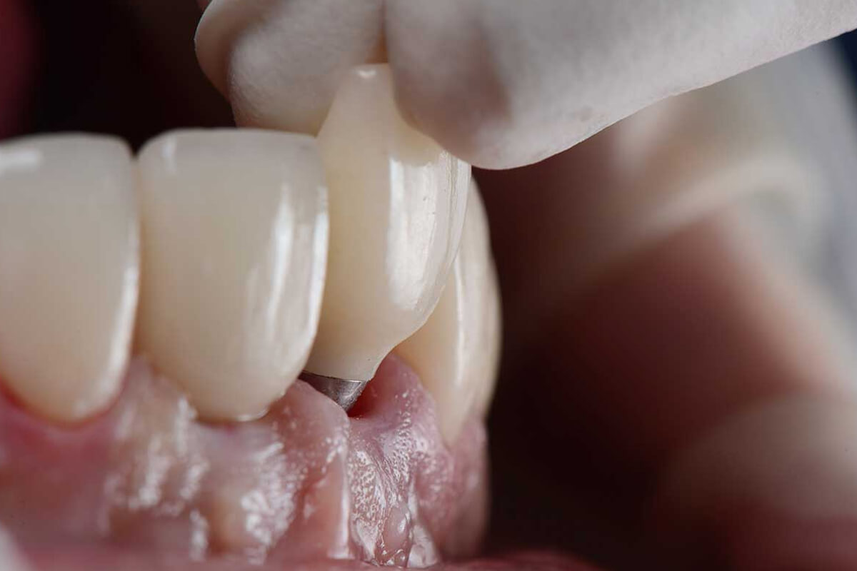 Düşen Diş Kaplaması Nasıl Yapıştırılır?