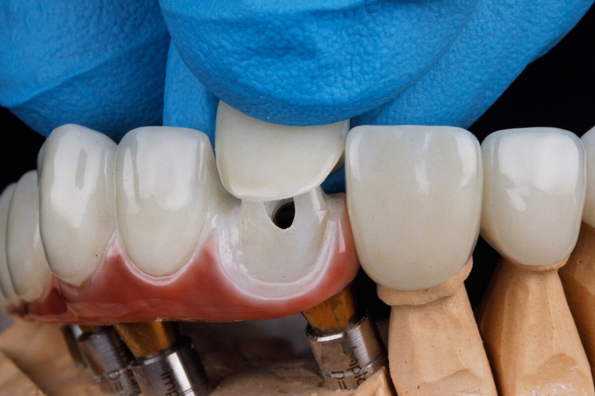 Kaplama Diş Kullanımının Dezavantajları