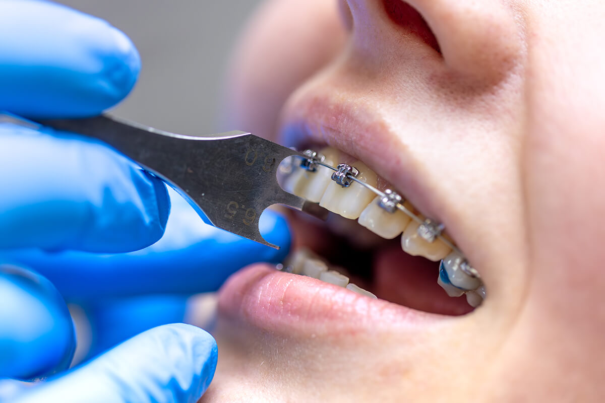 Ortodontik Tedavi Süreci