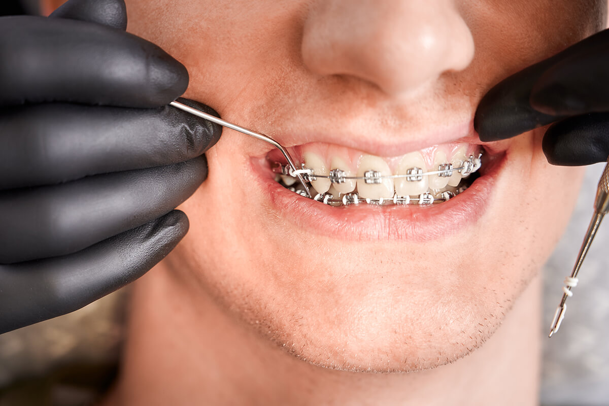 Ortodontik Tedavilerin Faydaları