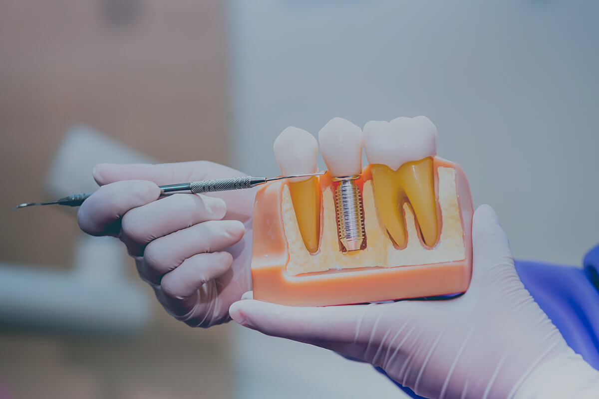 Samsun İmplant Tedavileri