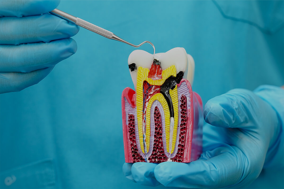 Samsun Kanal Tedavisi (Endodonti)