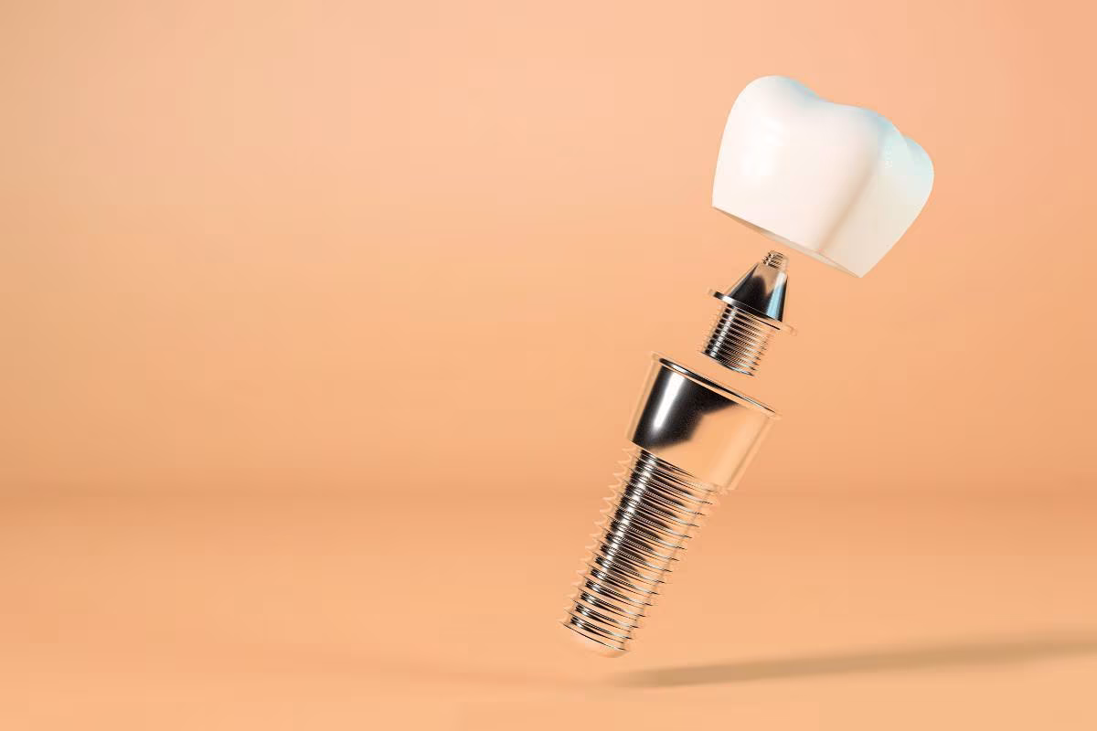 Titanyum İmplant Nedir?
